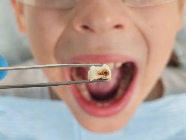 Best Emergency Treatment for Dental Infections or Abscesses in Warren Park, IN